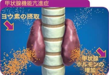 甲状腺機能亢進症